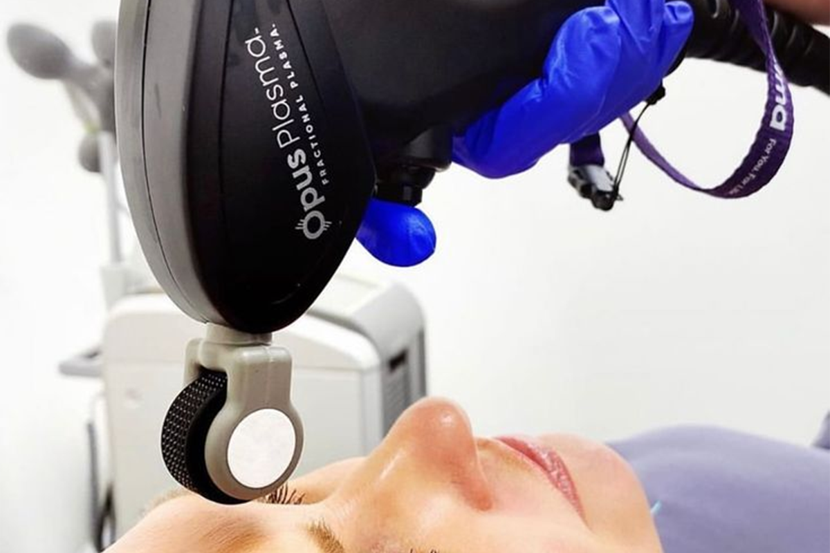 Alma Opus fractional plasma skin resurfacing at Summit Wellness & Spa in Anchorage, Alaska