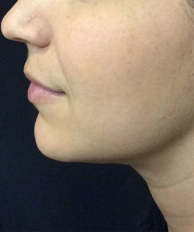 Kybella double chin fat reduction at Summit Wellness & Spa in Anchorage, Alaska