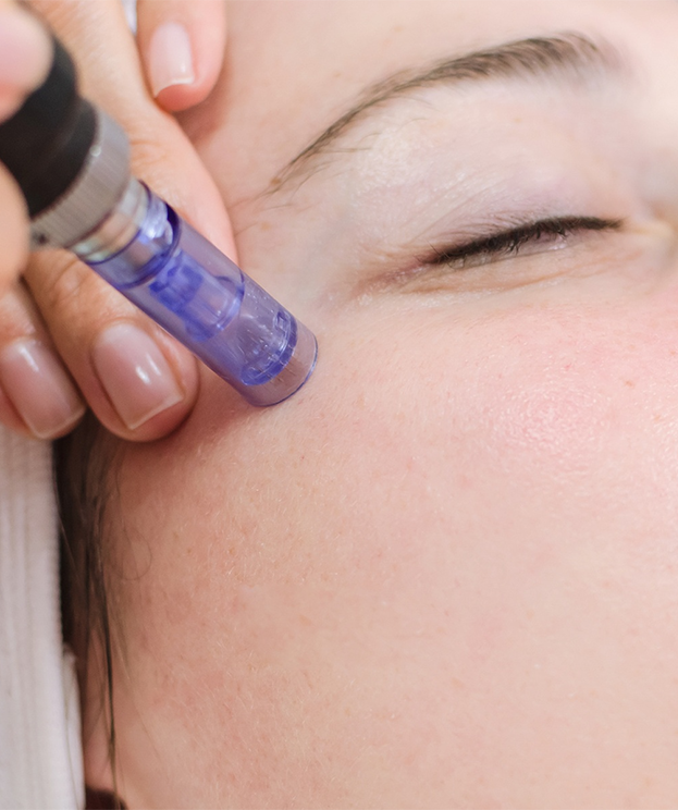 Microneedling collagen induction treatment at Summit Wellness & Spa in Anchorage, Alaska