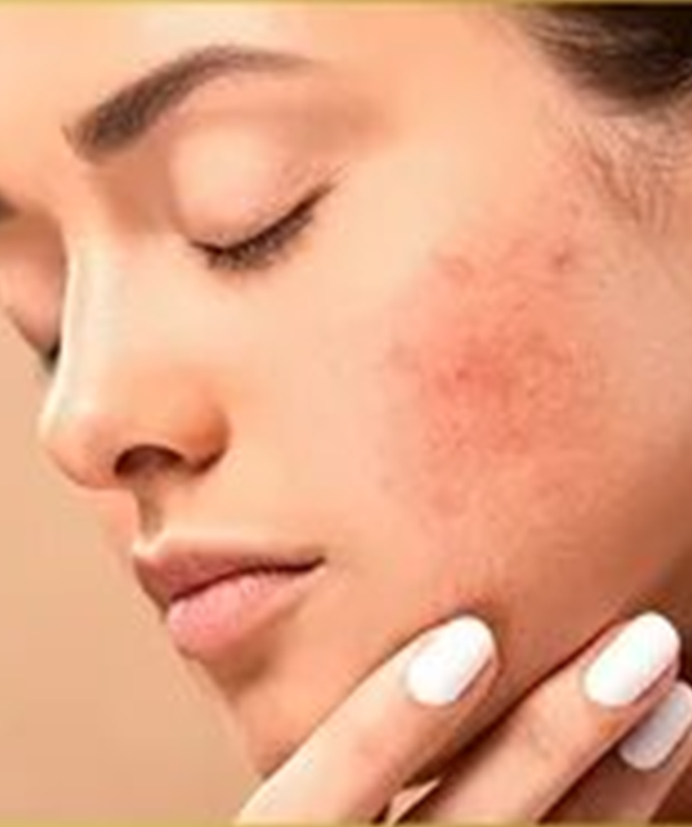 Acne treatment program at Summit Wellness & Spa in Anchorage, Alaska