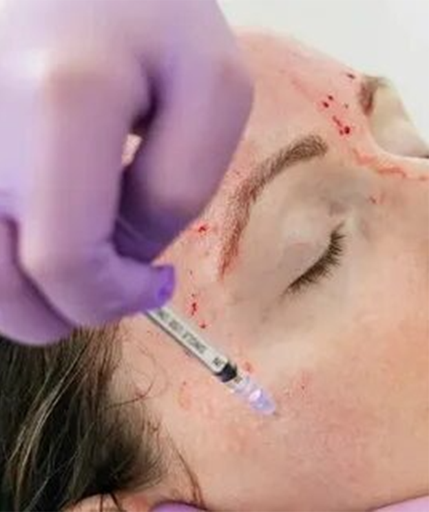 Vampire Facial PRP treatment at Summit Wellness & Spa in Anchorage, Alaska