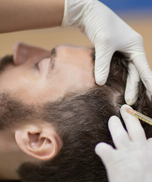 PRP hair restoration treatment at Summit Wellness & Spa in Anchorage, Alaska